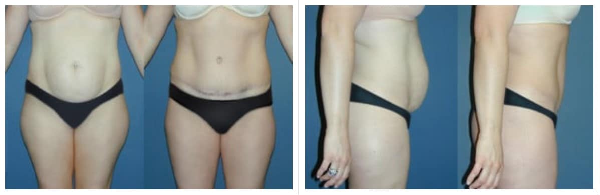Tummy Tuck In Lone Tree - Remove Excess Stomach Fat & Skin